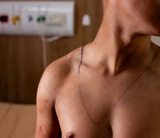 Jovem atingido por raio em ato de Nikolas teve hemorragia no ouvido