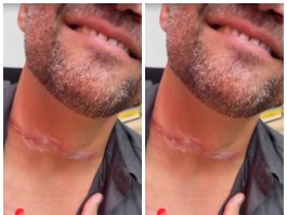 Secretário municipal sofre acidente com cabo solto e quase é gravemente ferido na capital